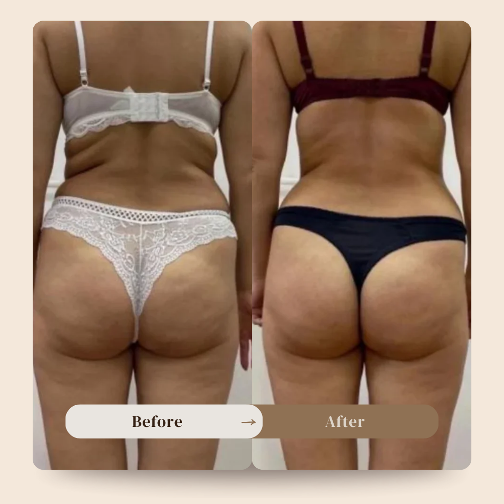 Anti cellulite massager