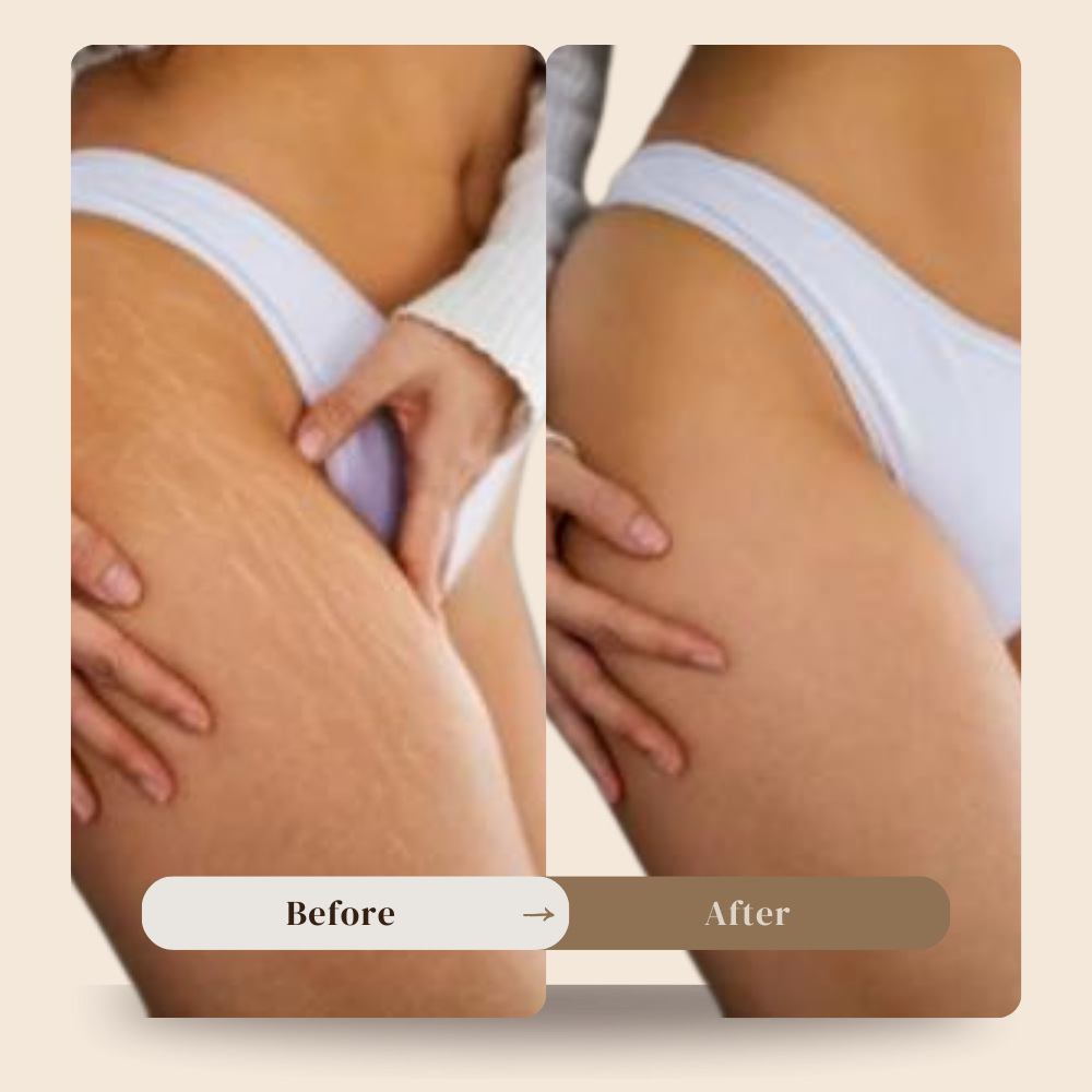 Anti cellulite massager