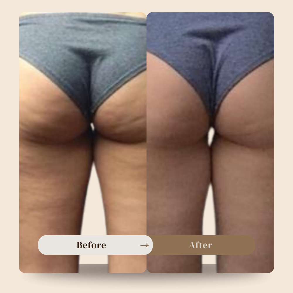 Anti cellulite massager