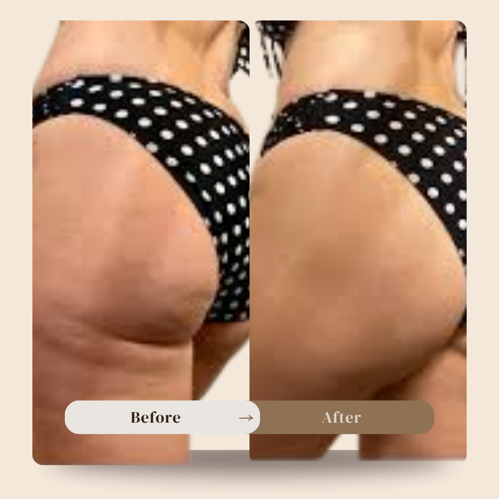 Anti cellulite massager